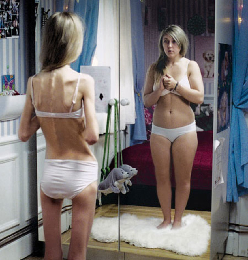 Image result for anorexia victim